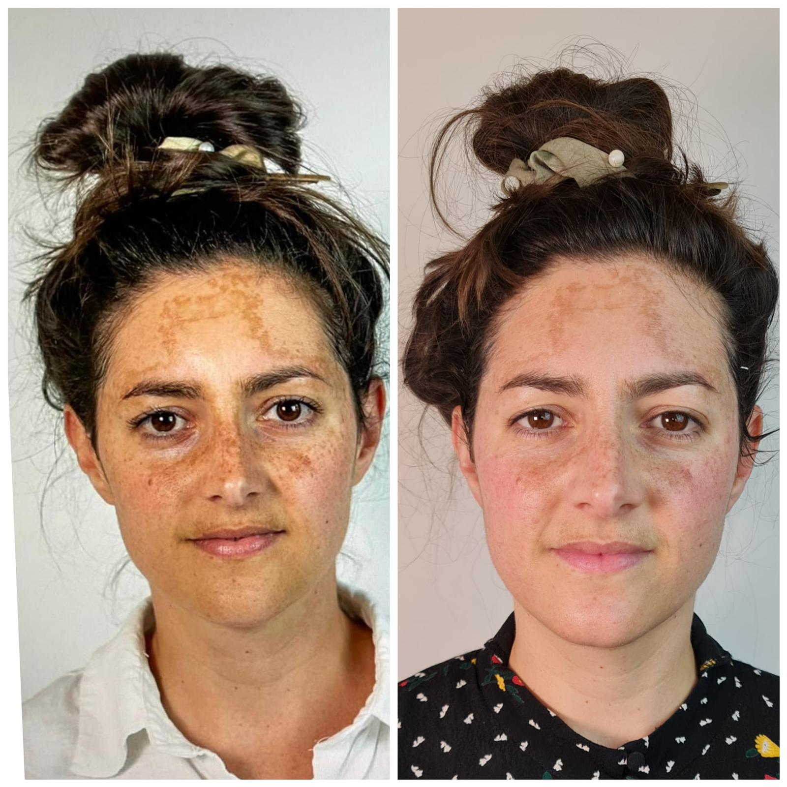 before and after of skinstorm treatment